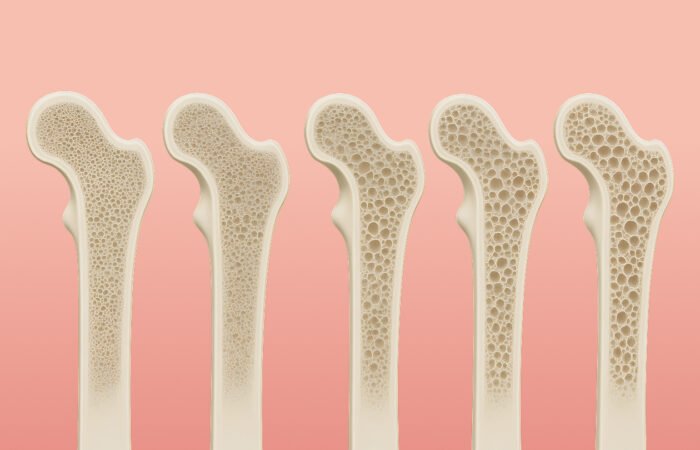 Blog-cover_Bone-Density Bone density